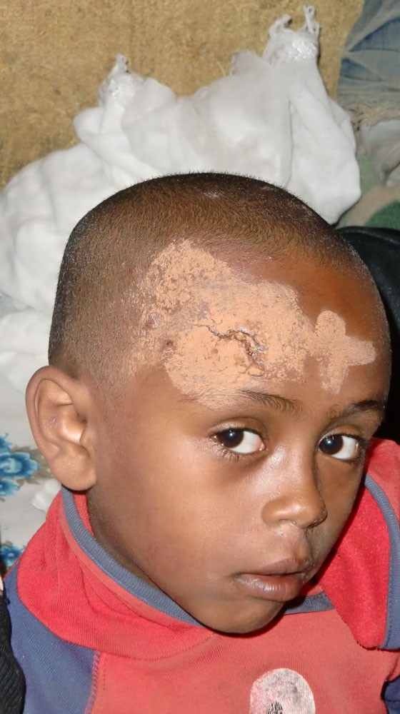 2013 Behailu Familie, Eremyas hat eine offene Infektion am Kopf